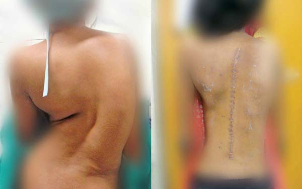The pictures shows the before and after effects of an operation on a patient suffering from scoliosis. (Photo: DC) The pictures shows the before and after effects of an operation on a patient suffering from scoliosis. (Photo: DC)